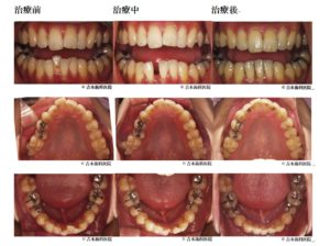 歯並び改善・マウスピース矯正なら香川県 高松市の吉本歯科医院